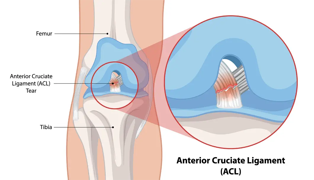 ACL Surgery in Indore