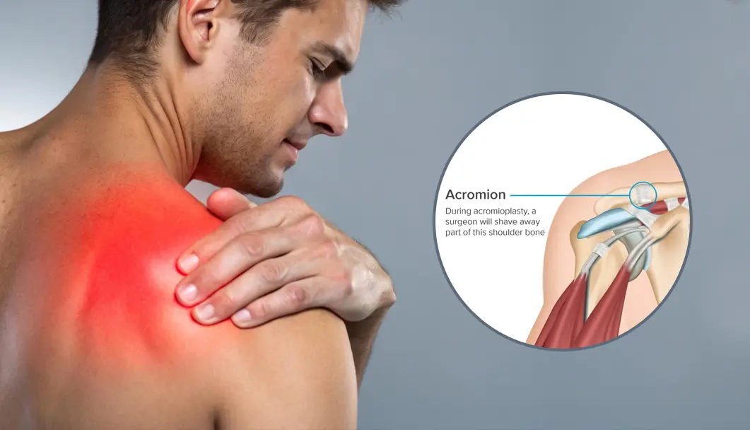 Frozen Shoulder Treatment in Indore