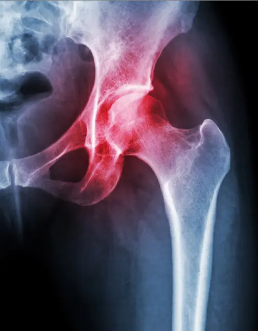 ACL Injury Doctor in Indore
