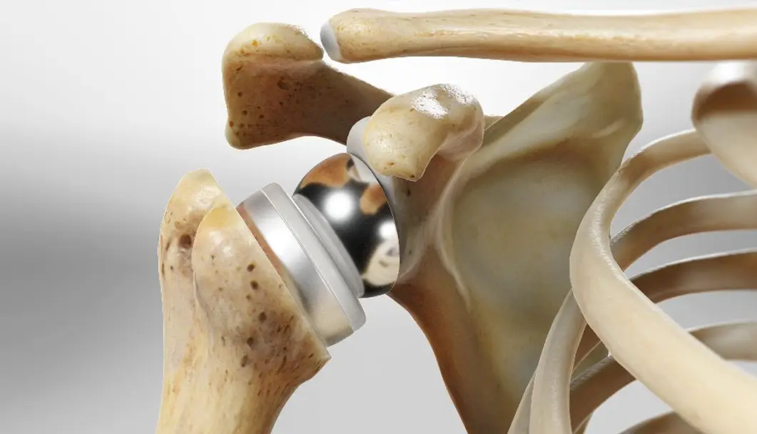Shoulder Surgeon in Indore