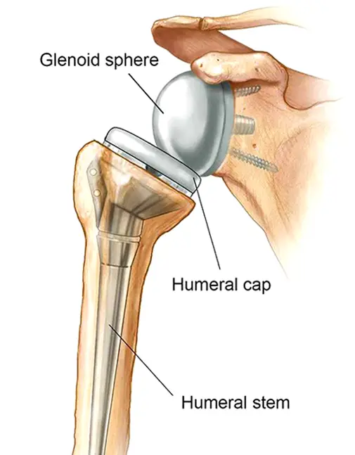 Best Shoulder Doctor in Indore