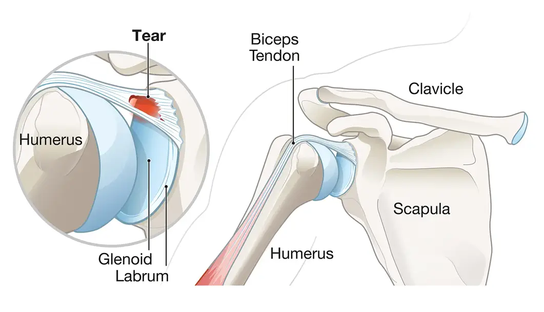 slap tear in indore