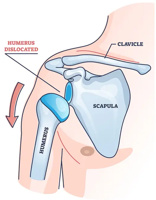 Shoulder Dislocation treatment in Indore