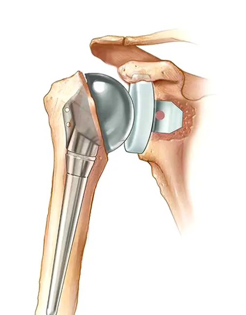 Shoulder Pain Treatment in Indore