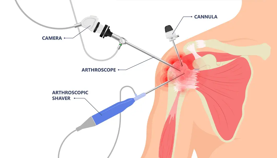 Shoulder Specialist in Indore